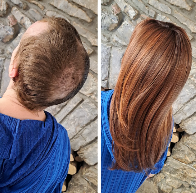 Non-surgical hair loss treatments